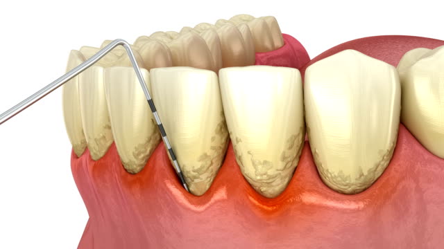 Understanding Gingivitis Symptoms And The Importance Of Dental Bone Grafting