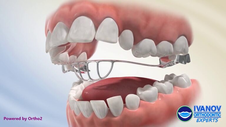 What are the Benefits of Using A Tongue Crib in Orthodontics?