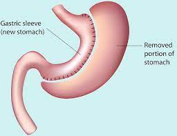 Exploring the Effectiveness of Gastric Band Hypnotherapy in Weight Management