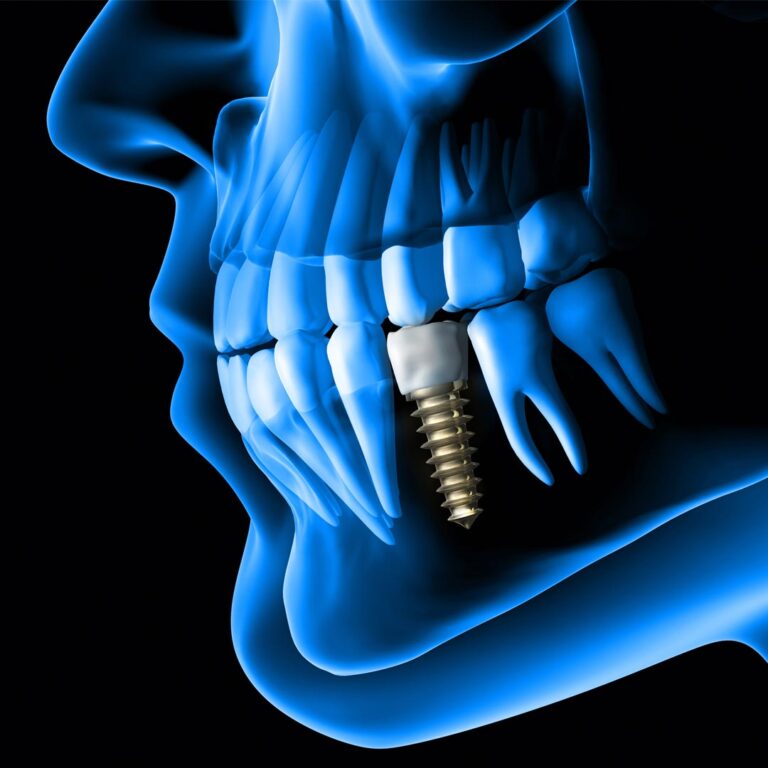 FAQs about Dental Implant Treatments in Dubai