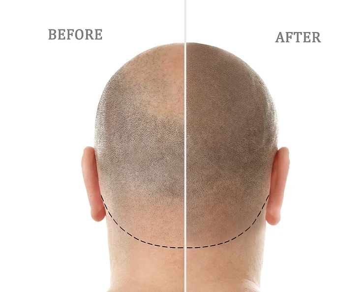 The Various Reasons To Choose A Scalp Micropigmentation Explained in Dubai | Eden Aesthetics Clinic